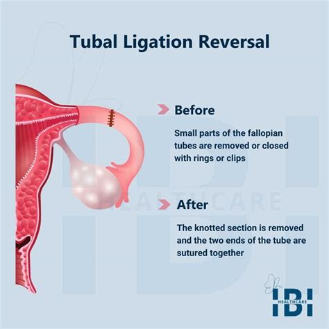 sex tubes|Tubal ligation